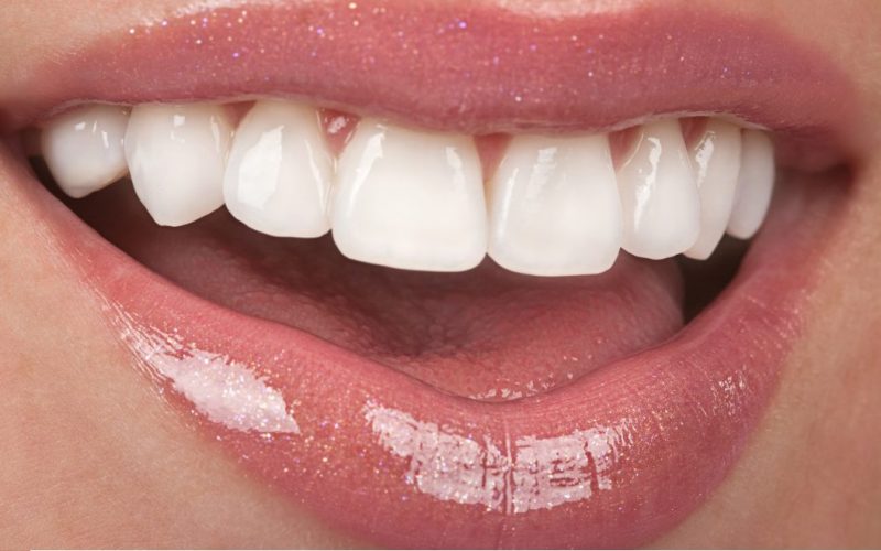 تركيبات الايماكس للأسنان: دليلك الشامل