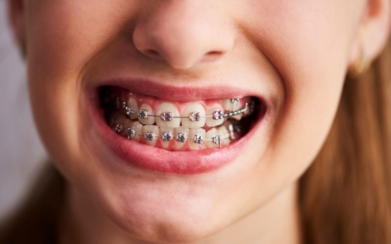 تقويم الأسنان: أفضل الأنواع والمزايا والمخاطر